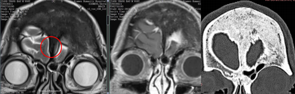 術(shù)前MRI.png